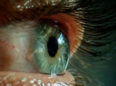 Il sonno scarso fa sì che le palpebre di una donna diventino così flosce che si ribaltano, rimanendo bloccate