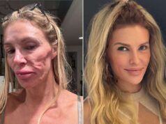 Brandi Glanville rivela cosa le ha causato i parassiti in bocca