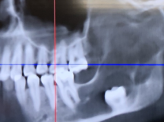 Una donna pensa che i suoi denti del giudizio debbano essere rimossi: i chirurghi trovano qualcos’altro