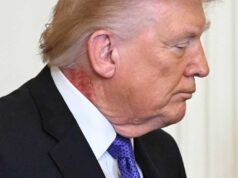 Donald Trump ha fatto debuttare una nuova condizione della pelle, spiega il medico della Casa Bianca