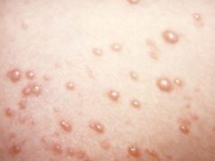 Nel raro caso della varicella, le vesciche pruriginose si trasformano in grandi noduli gommosi